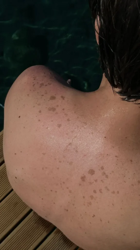 What Is a Second-Degree Sunburn